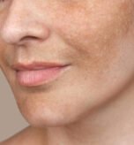 Melasma vs. Dark Spots: Understanding Facial Pigmentation and Treatment Options in Dubai