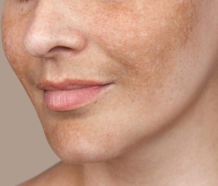 Melasma vs. Dark Spots: Understanding Facial Pigmentation and Treatment Options in Dubai
