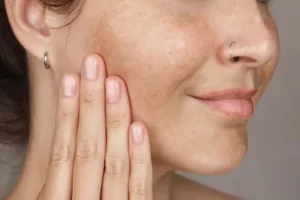 What Is Facial Pigmentation?